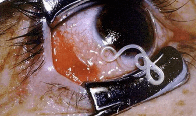 أنواع الطفيليات في جسم الإنسان